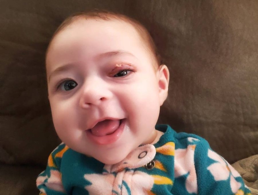 Eleanor, who had surgery at three months old